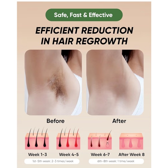 Xsoul Handheld IPL Hair Removal Device At Home Laser Permanent Hair Removal - Picture 10 of 14